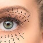 Blepharoplasty in Dubai